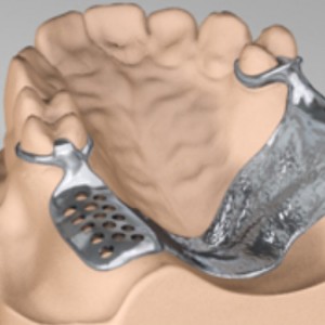 Лита система для часткових зубних протезів